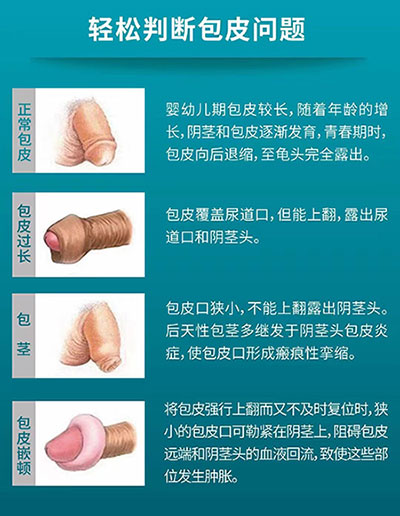 齐齐哈尔中都男科医院包皮包茎